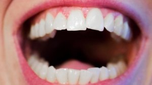 How to Make White Teeth Naturally
